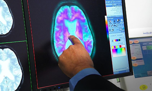 You are currently viewing Dementia becomes Australia leading killer in a shocking new milestone